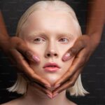 Beyaz Kas Hastalığı Nedir